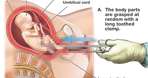 【画像】堕胎手術の方法を紹介した画像がグロすぎる件…